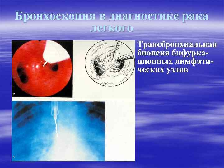 Бронхоскопия в диагностике рака легкого Трансбронхиальная биопсия бифуркационных лимфатических узлов 