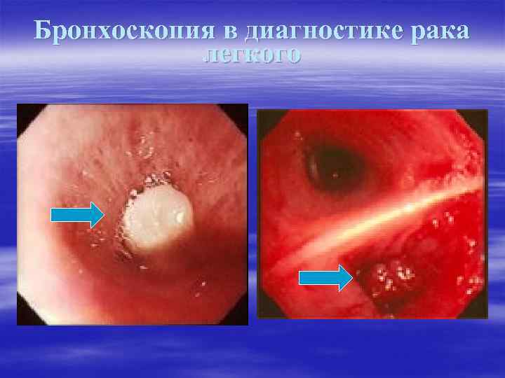 Бронхоскопия в диагностике рака легкого 