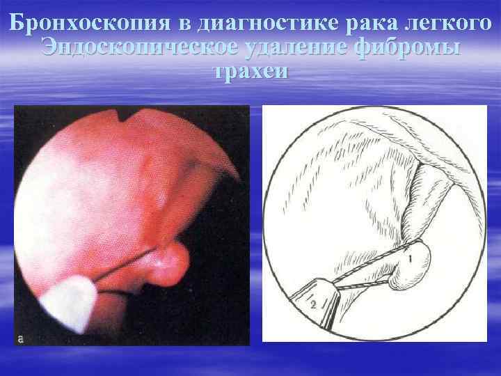 Бронхоскопия в диагностике рака легкого Эндоскопическое удаление фибромы трахеи 