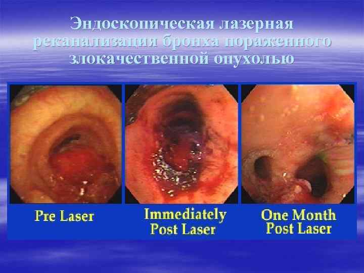 Эндоскопическая лазерная реканализация бронха пораженного злокачественной опухолью 