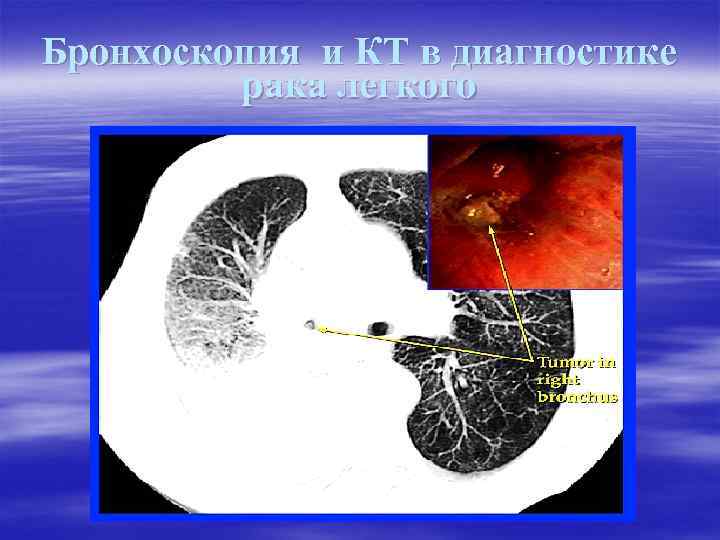 Бронхоскопия и КТ в диагностике рака легкого 