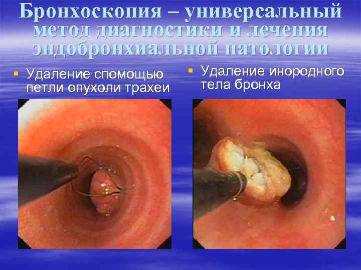 Бронхоскопия – универсальный метод диагностики и лечения эндобронхиальной патологии § Удаление спомощью петли опухоли