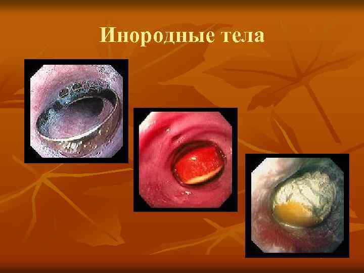 Инородные тела 