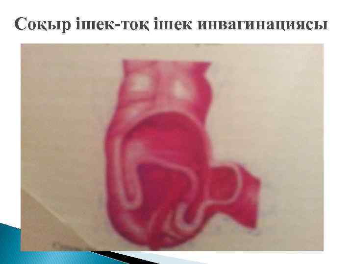 Соқыр ішек-тоқ ішек инвагинациясы 