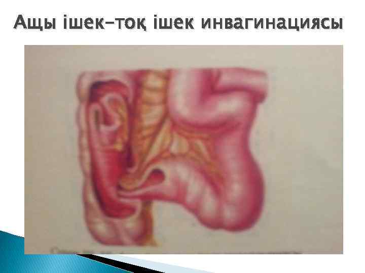 Ащы ішек-тоқ ішек инвагинациясы 