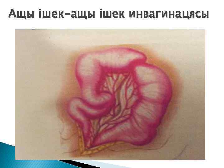 Ащы ішек-ащы ішек инвагинацясы 