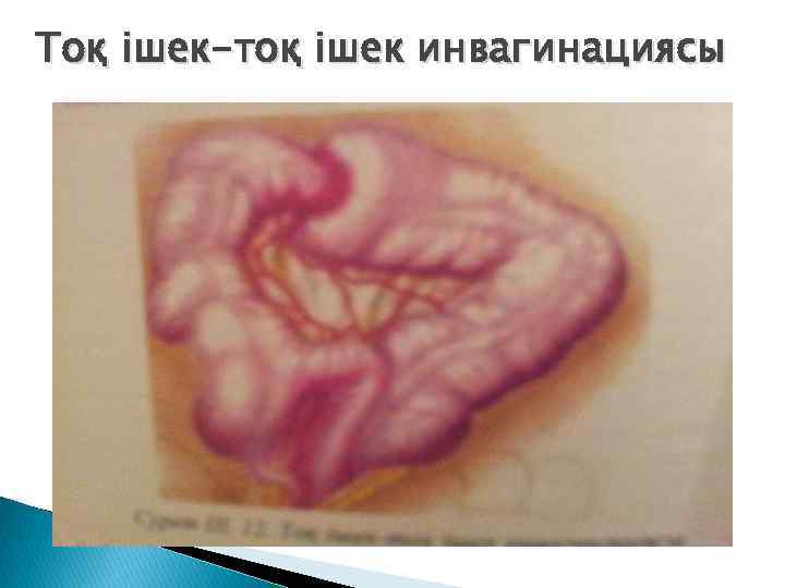 Тоқ ішек-тоқ ішек инвагинациясы 