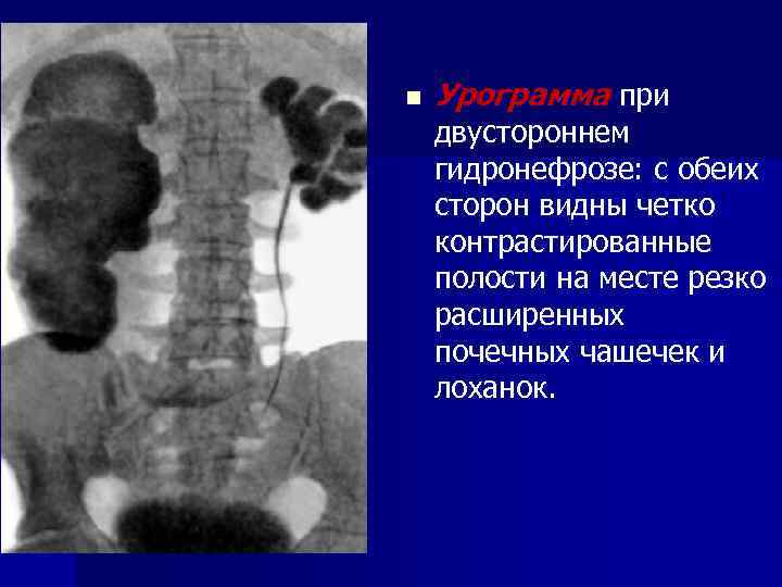 n Урограмма при двустороннем гидронефрозе: с обеих сторон видны четко контрастированные полости на месте