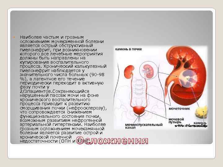 Мочекаменная болезнь осложнения. Калькулезный пиелонефрит. Калькулезный пиелонефрит почек. Мочекаменная болезнь и пиелонефрит. Обтурационный пиелонефрит.