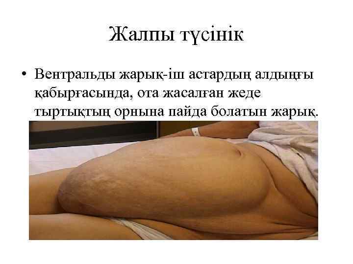 Жалпы түсінік • Вентральды жарық-іш астардың алдыңғы қабырғасында, ота жасалған жеде тыртықтың орнына пайда