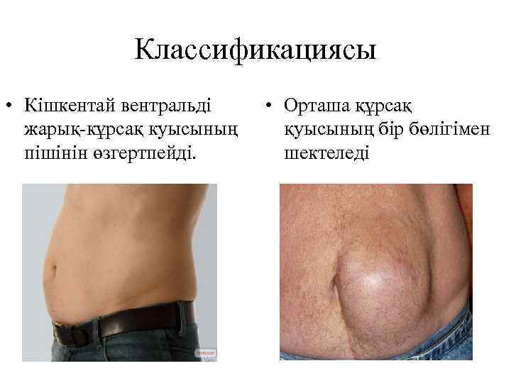 Классификациясы • Кішкентай вентральді жарық-кұрсақ куысының пішінін өзгертпейді. • Орташа құрсақ қуысының бір бөлігімен