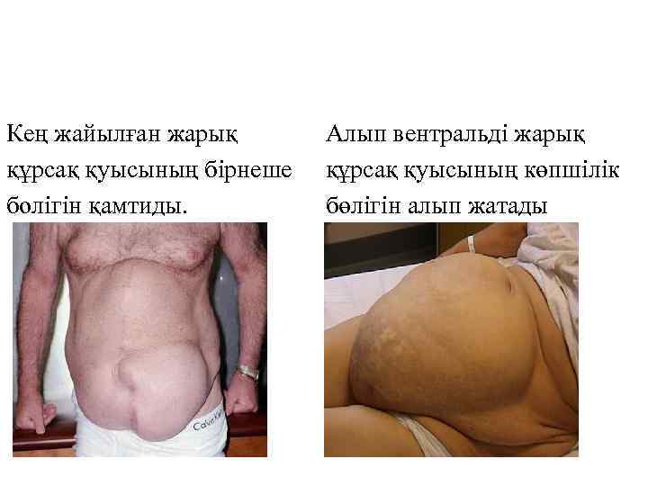 Кең жайылған жарық құрсақ қуысының бірнеше болігін қамтиды. Алып вентральді жарық құрсақ қуысының көпшілік