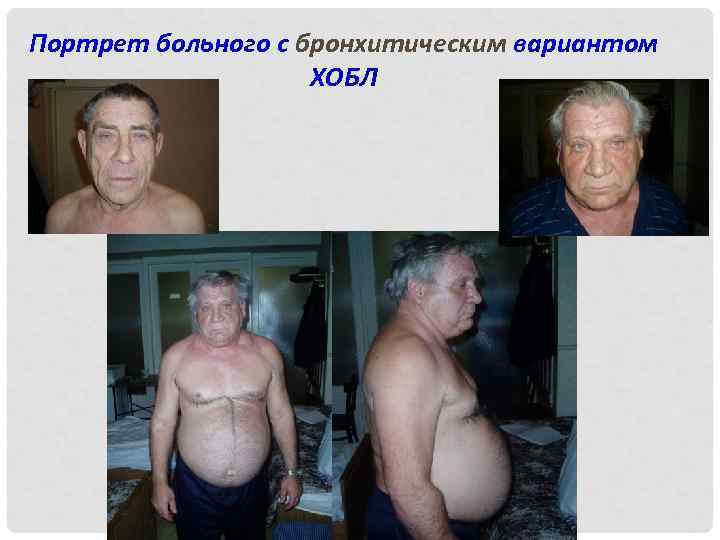 Портрет больного с бронхитическим вариантом ХОБЛ 