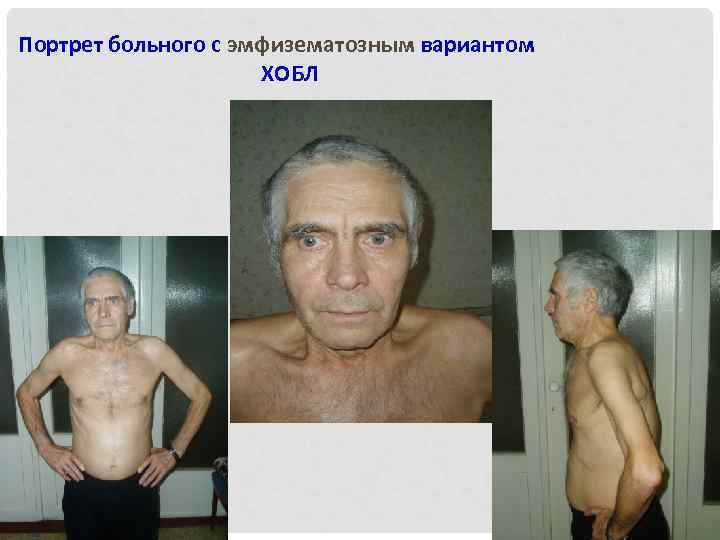 Портрет больного с эмфизематозным вариантом ХОБЛ 