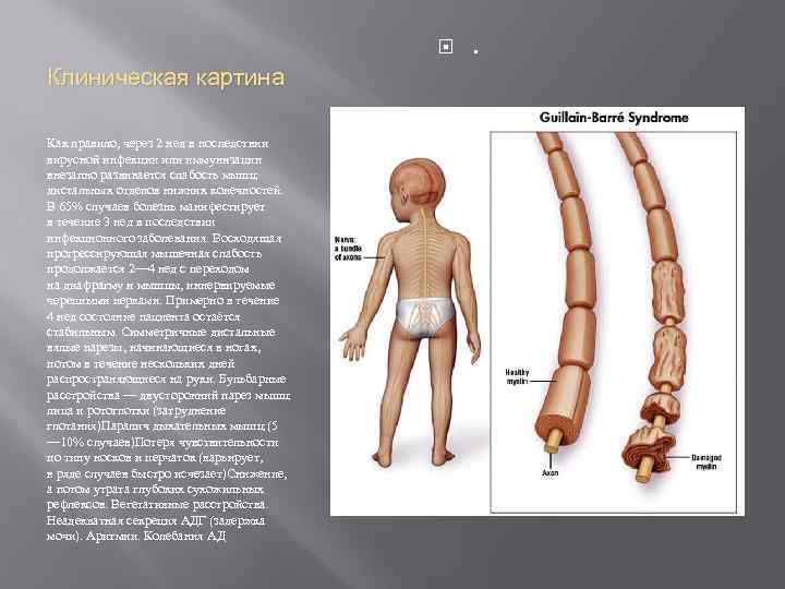 Клиническая картина Как правило, через 2 нед в последствии вирусной инфекции или иммунизации