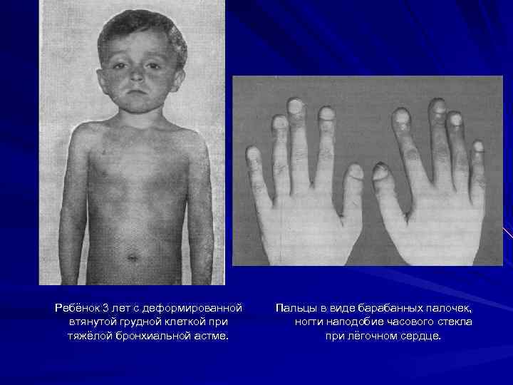 Ребёнок 3 лет с деформированной втянутой грудной клеткой при тяжёлой бронхиальной астме. Пальцы в