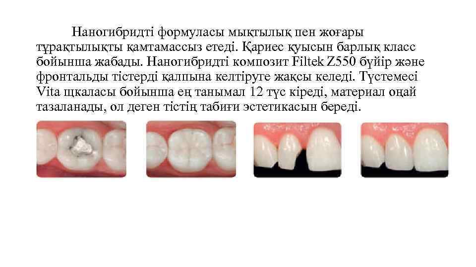 Наногибридті формуласы мықтылық пен жоғары тұрақтылықты қамтамассыз етеді. Қариес қуысын барлық класс бойынша жабады.