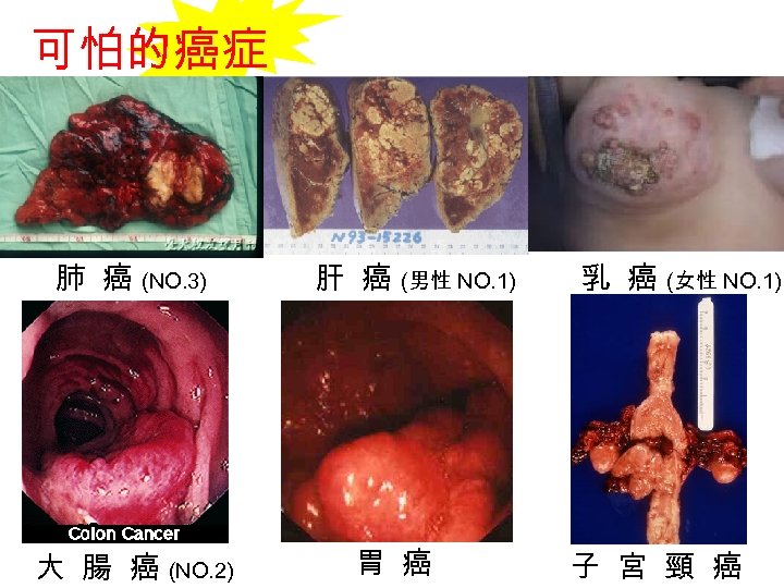 可怕的癌症 肺 癌 (NO. 3) 大 腸 癌 (NO. 2) 肝 癌 (男性 NO.