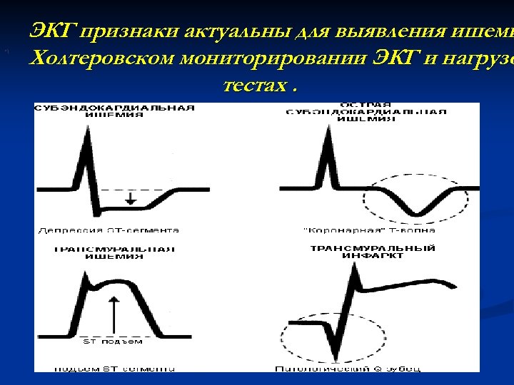  • ) ЭКГ признаки актуальны для выявления ишеми Холтеровском мониторировании ЭКГ и нагрузо