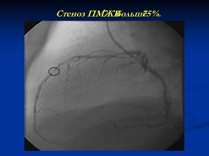 Окклюзия пка. Коронарография стеноз ПМЖВ. Проксимальный стеноз ПМЖВ.