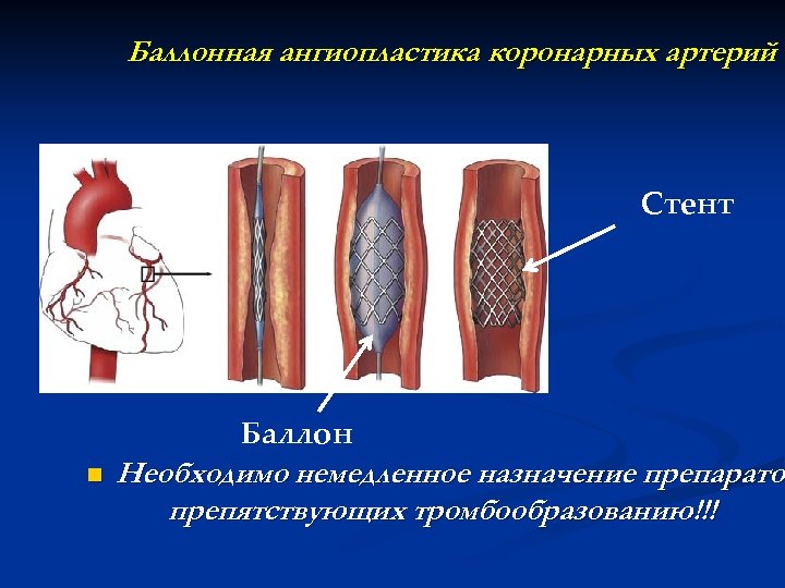 Транслюминальная ангиопластика. Баллонная ангиопластика и стентирование. Баллонная ангиопластика сосудов сердца.