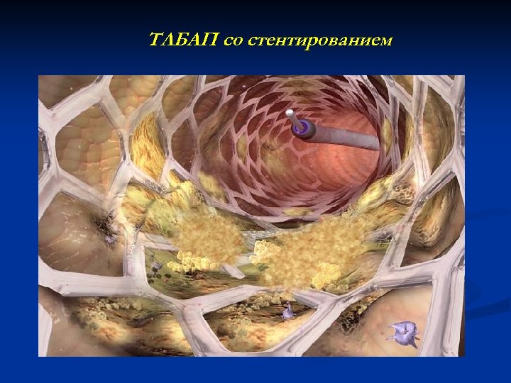 ТЛБАП со стентированием 
