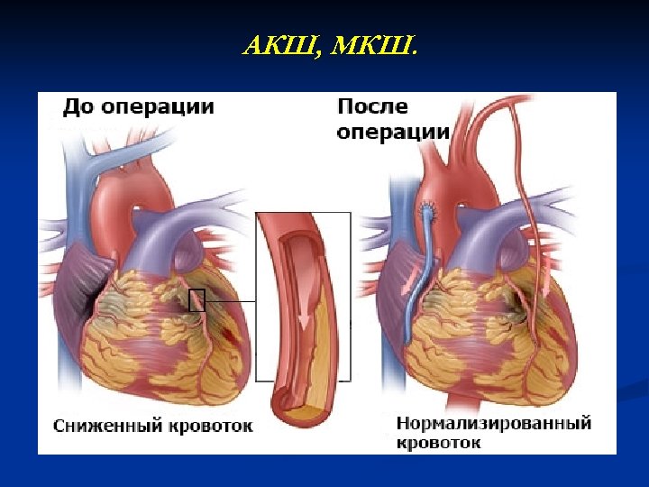 Операция какого либо. Инфаркт миокарда операция стентирование. Инфаркт миокарда операция шунтирование. Операция шунтирование сердца инфаркт. Что такое шунтирование сердца при инфаркте миокарда.