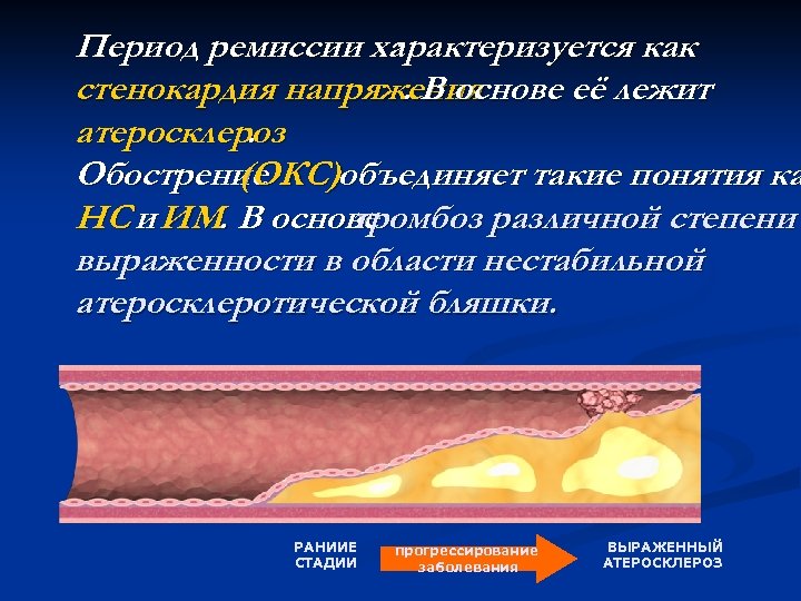 . Период ремиссии характеризуется как стенокардия напряжения. В основе её лежит атеросклероз. Обострение (ОКС)объединяет