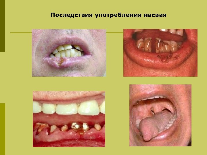 Последствия употребления насвая 