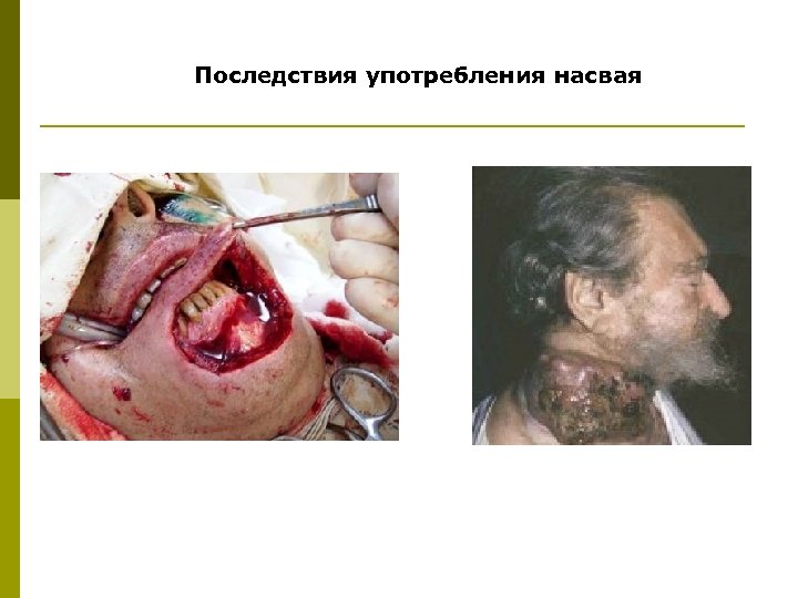 Последствия употребления насвая 