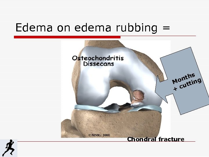 Edema on edema rubbing = s nth g Mo ttin u +c Chondral fracture