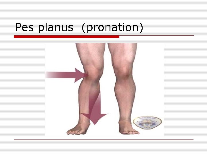 Pes planus (pronation) 