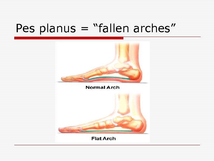 Pes planus = “fallen arches” 