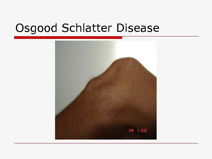 Osgood Schlatter Disease 