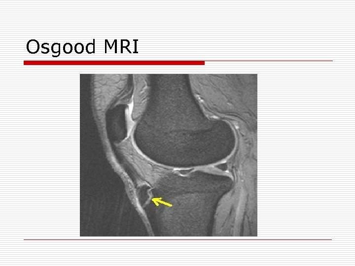 Osgood MRI 