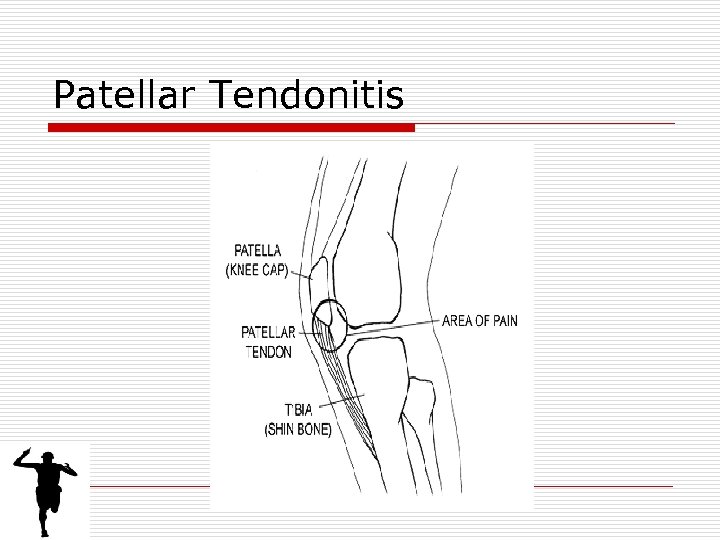 Patellar Tendonitis 