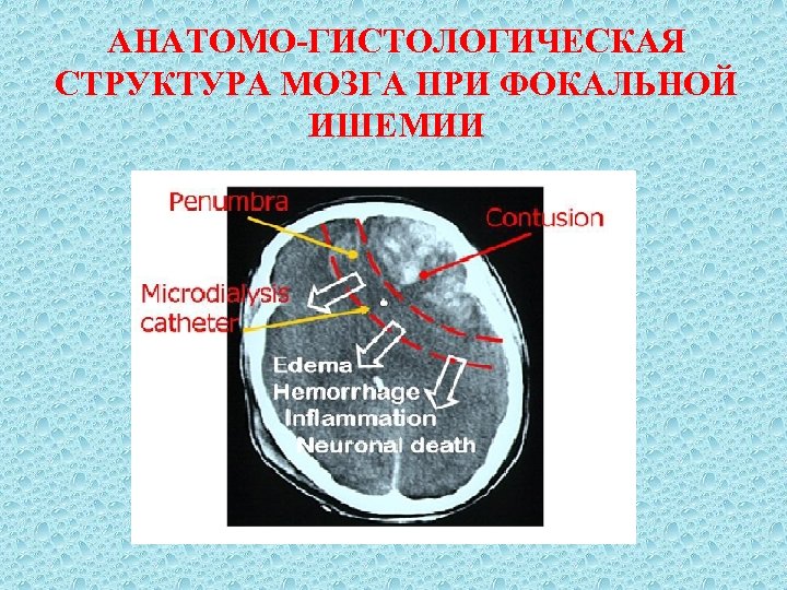 АНАТОМО ГИСТОЛОГИЧЕСКАЯ СТРУКТУРА МОЗГА ПРИ ФОКАЛЬНОЙ ИШЕМИИ 