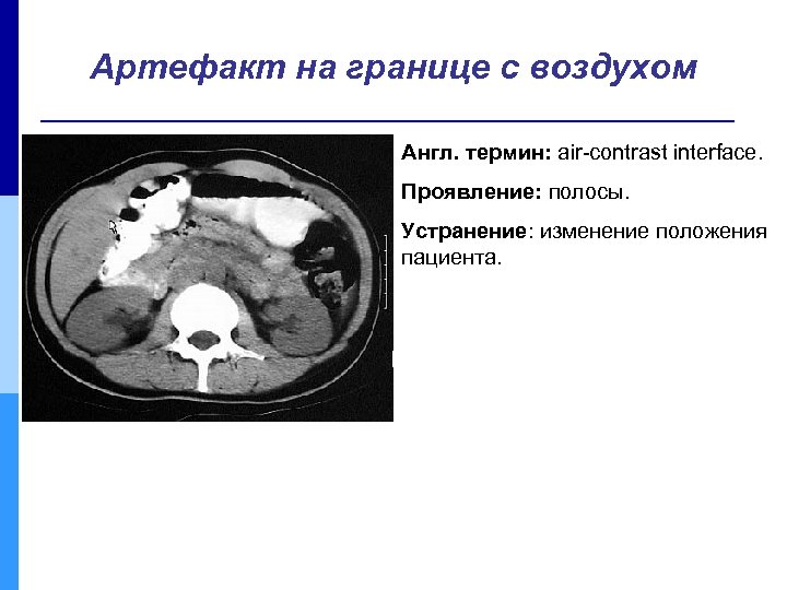 Артефакт на границе с воздухом Англ. термин: air-contrast interface. Проявление: полосы. Устранение: изменение положения