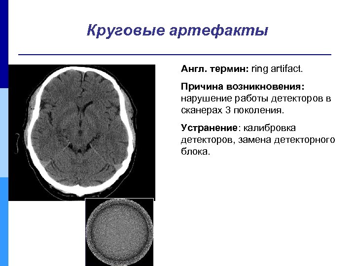Круговые артефакты Англ. термин: ring artifact. Причина возникновения: нарушение работы детекторов в сканерах 3