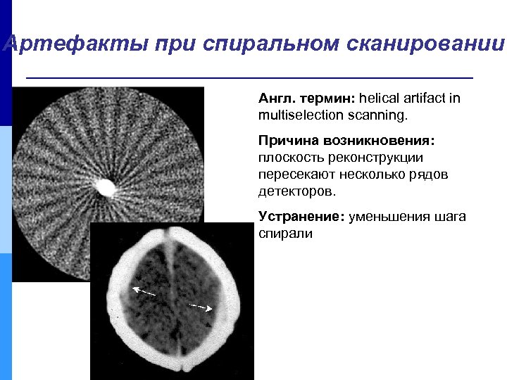 Артефакты при спиральном сканировании Англ. термин: helical artifact in multiselection scanning. Причина возникновения: плоскость