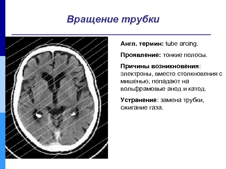 Вращение трубки Англ. термин: tube arcing. Проявление: тонкие полосы. Причины возникновения: электроны, вместо столкновения