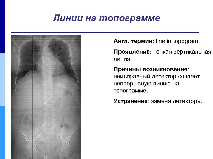 Линии на топограмме Англ. термин: line in topogram. Проявление: тонкая вертикальная линия. Причины возникновения:
