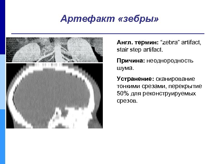 Артефакт «зебры» Англ. термин: “zebra” artifact, stair step artifact. Причина: неоднородность шума. Устранение: сканирование