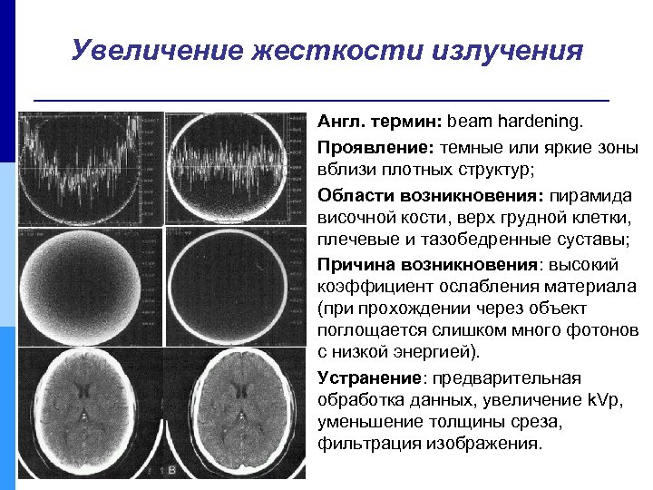 Увеличение жесткости излучения Англ. термин: beam hardening. Проявление: темные или яркие зоны вблизи плотных