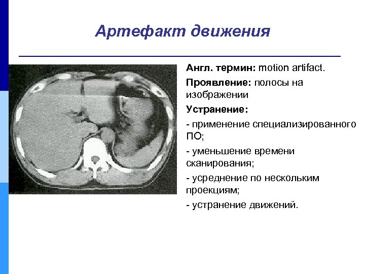 Артефакт движения Англ. термин: motion artifact. Проявление: полосы на изображении Устранение: - применение специализированного