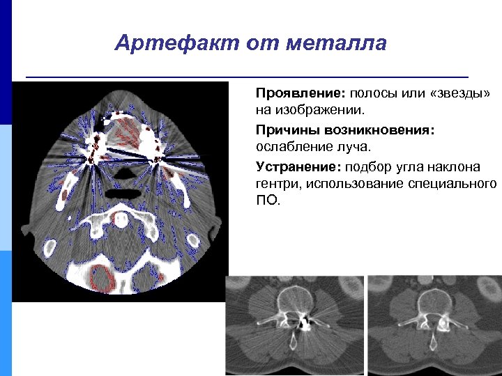 Артефакт от металла Проявление: полосы или «звезды» на изображении. Причины возникновения: ослабление луча. Устранение: