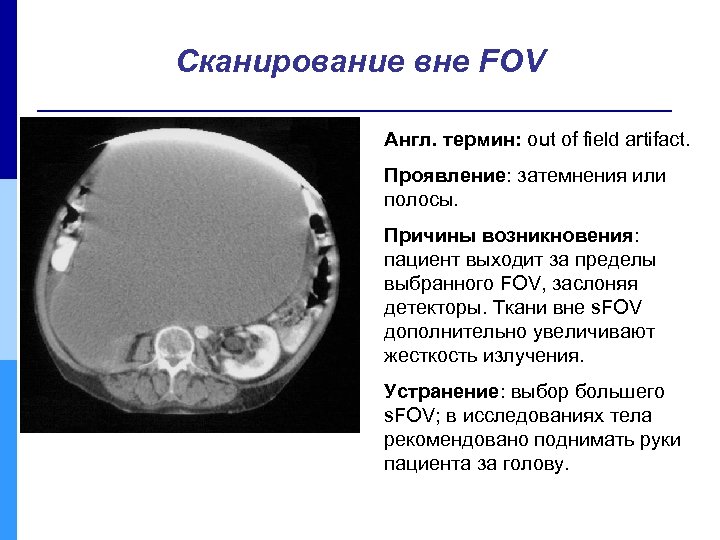 Сканирование вне FOV Англ. термин: out of field artifact. Проявление: затемнения или полосы. Причины