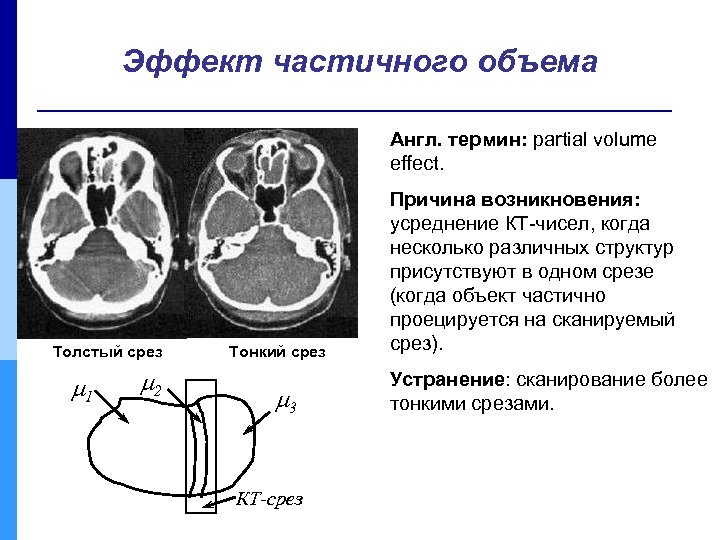 Эффект частичного объема Англ. термин: partial volume effect. Толстый срез 1 2 Тонкий срез