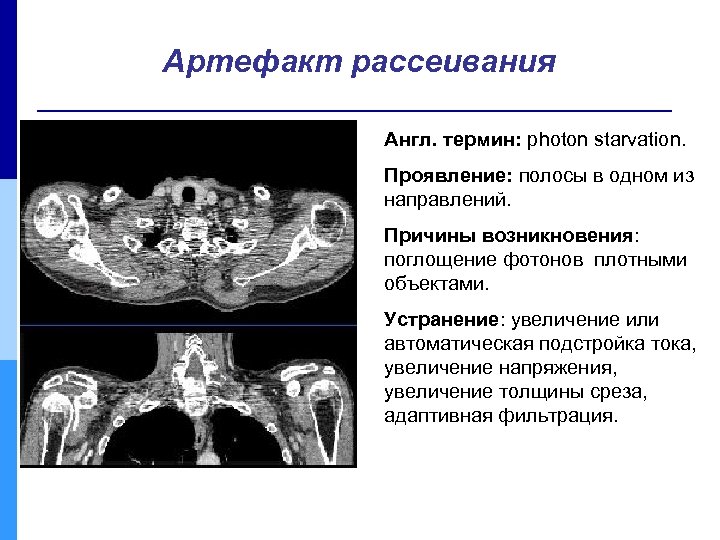 Артефакт рассеивания Англ. термин: photon starvation. Проявление: полосы в одном из направлений. Причины возникновения: