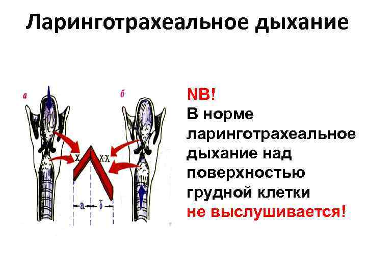 Ларинготрахеальное дыхание NB! В норме ларинготрахеальное дыхание над поверхностью грудной клетки не выслушивается! 